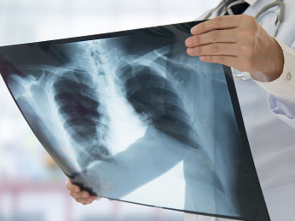 thumbnail of Small Plastic Particles Now Found Deep Inside Human Lungs